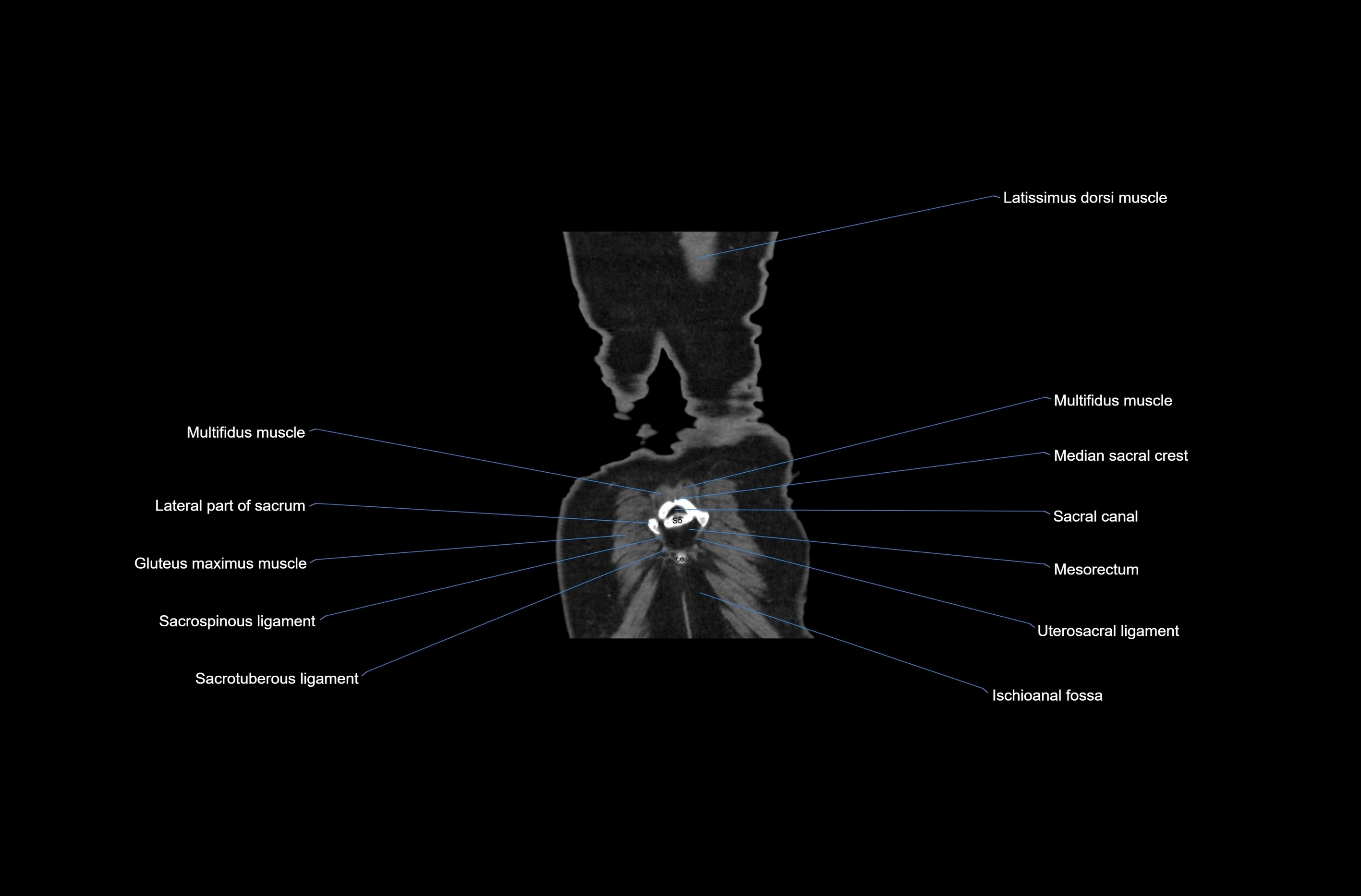 CT abdomen coronal cross sectional anatomy labelled radiology image-00082.webp